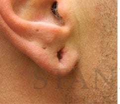 Earlobe Repair Before & After Patient #420