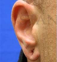 Earlobe Repair Before & After Patient #420