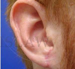 Earlobe Repair Before & After Patient #407