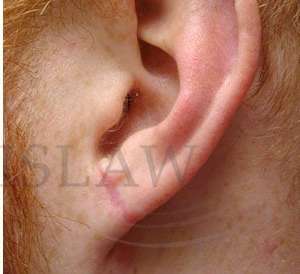 Earlobe Repair Before & After Patient #407