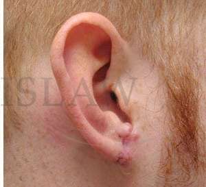 Earlobe Repair Before & After Patient #407