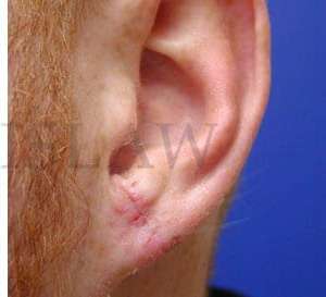 Earlobe Repair Before & After Patient #407