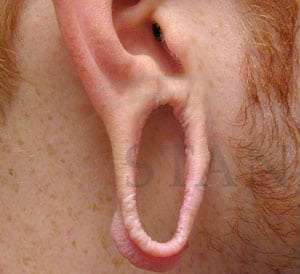 Earlobe Repair Before & After Patient #407