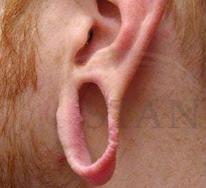 Earlobe Repair Before & After Patient #407