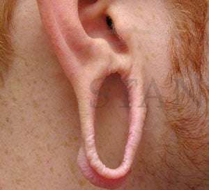 Earlobe Repair Before & After Patient #407