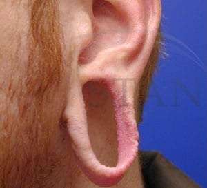 Earlobe Repair Before & After Patient #407