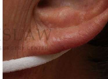 Earlobe Repair Before & After Patient #380