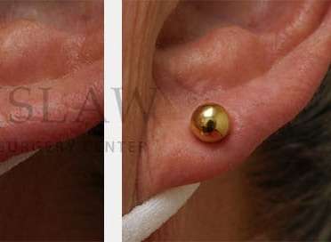 Earlobe Repair Before & After Patient #380