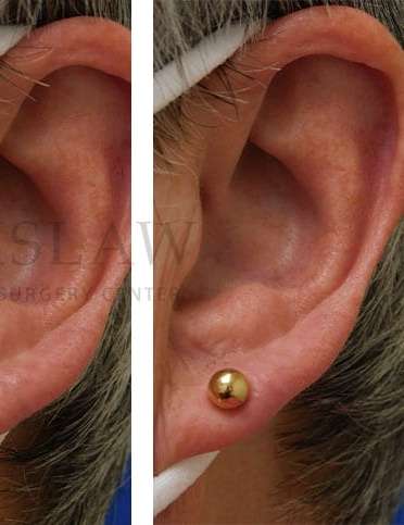Earlobe Repair Before & After Patient #380