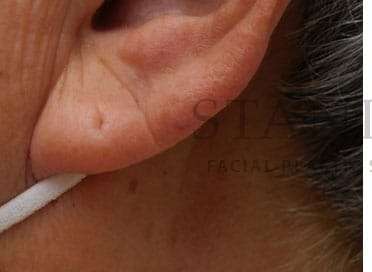 Earlobe Repair Before & After Patient #380