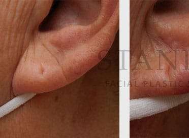 Earlobe Repair Before & After Patient #380
