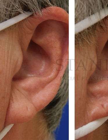 Earlobe Repair Before & After Patient #380