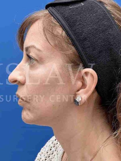 Face/Neck Lift Before & After Patient #454