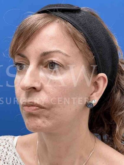Face/Neck Lift Before & After Patient #454