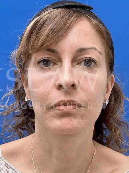Face/Neck Lift Before & After Patient #454