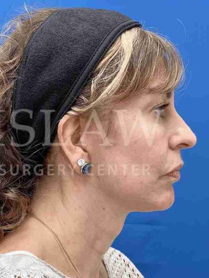 Face/Neck Lift Before & After Patient #454