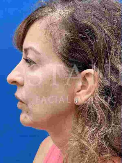 Face/Neck Lift Before & After Patient #454