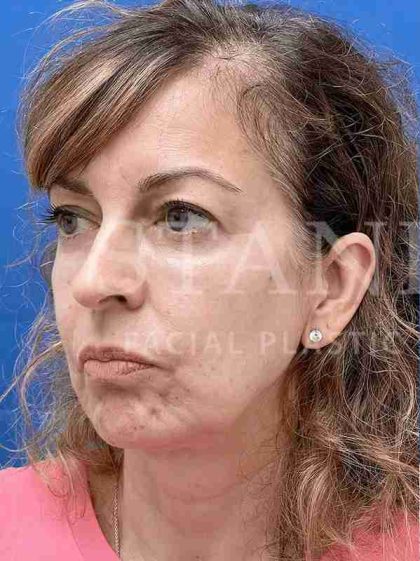 Face/Neck Lift Before & After Patient #454