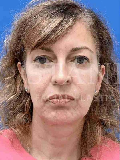 Face/Neck Lift Before & After Patient #454