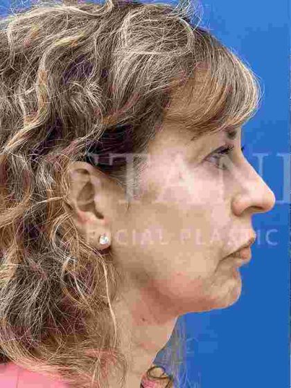 Face/Neck Lift Before & After Patient #454
