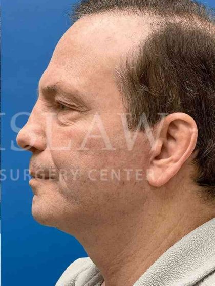 Face/Neck Lift Before & After Patient #445