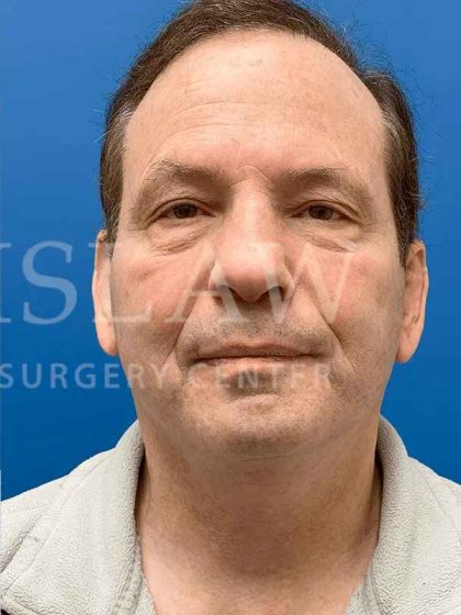 Face/Neck Lift Before & After Patient #445