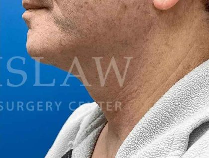 Face/Neck Lift Before & After Patient #445
