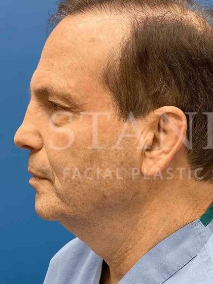 Face/Neck Lift Before & After Patient #445