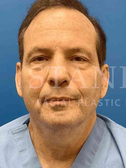 Face/Neck Lift Before & After Patient #445