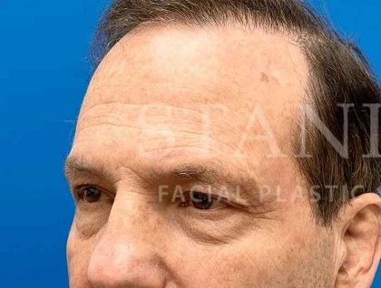 Face/Neck Lift Before & After Patient #445