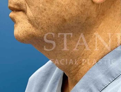 Face/Neck Lift Before & After Patient #445