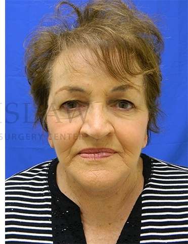 Face/Neck Lift Before & After Patient #584