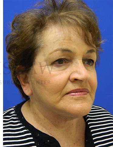 Face/Neck Lift Before & After Patient #584
