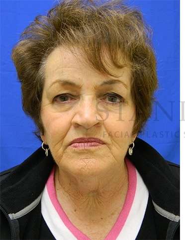 Face/Neck Lift Before & After Patient #584