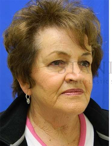 Face/Neck Lift Before & After Patient #584