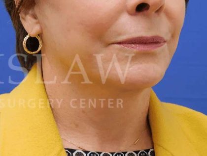 Face/Neck Lift Before & After Patient #463