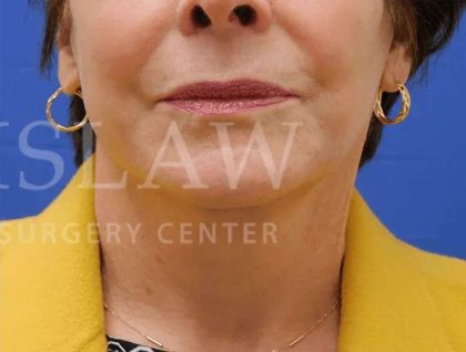Face/Neck Lift Before & After Patient #463