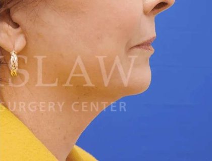 Face/Neck Lift Before & After Patient #463