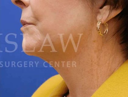 Face/Neck Lift Before & After Patient #463