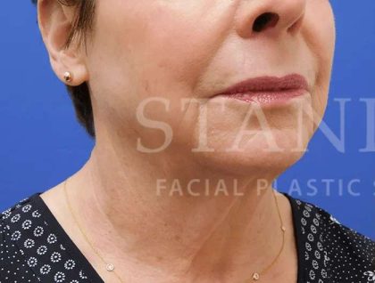 Face/Neck Lift Before & After Patient #463