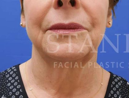 Face/Neck Lift Before & After Patient #463