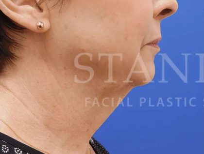 Face/Neck Lift Before & After Patient #463