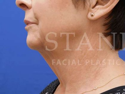 Face/Neck Lift Before & After Patient #463