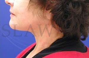 Face/Neck Lift Before & After Patient #579