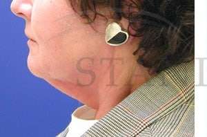 Face/Neck Lift Before & After Patient #579