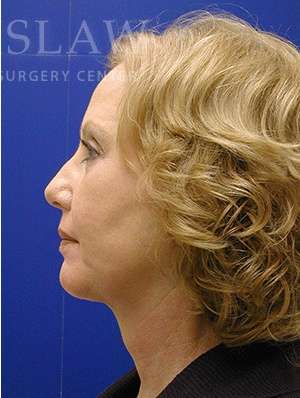 Face/Neck Lift Before & After Patient #576