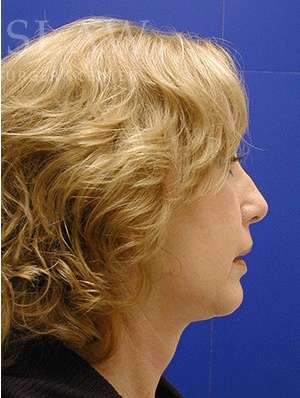 Face/Neck Lift Before & After Patient #576