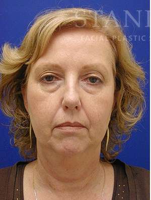 Face/Neck Lift Before & After Patient #576