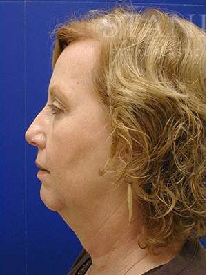 Face/Neck Lift Before & After Patient #576