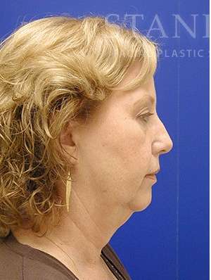 Face/Neck Lift Before & After Patient #576